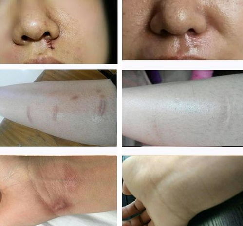 女人有五种疤痕影响运势 你是哪一种