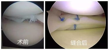 80岁了，有必要换半月板吗