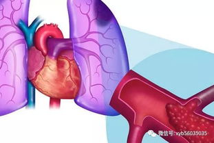 PNH 严重影响到生存质量的疾病 