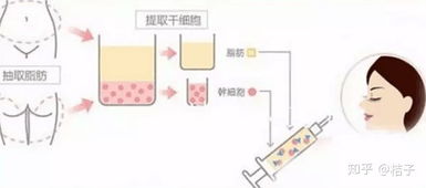 干细胞填充法令纹效果怎么样 填充一次可以维持多久 