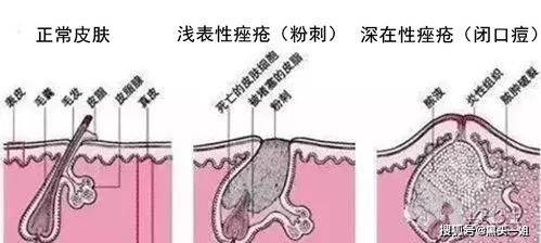 长闭口痘,该怎么去除