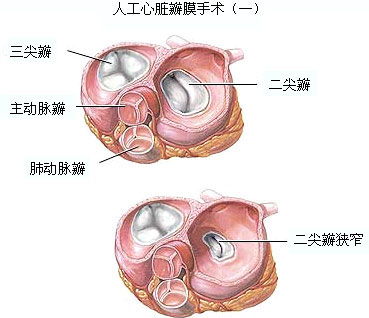 人工心脏瓣膜的2. 当前使用的人工心脏瓣膜 
