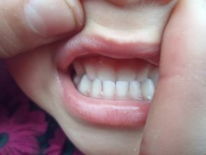 乳牙反颌的介绍 