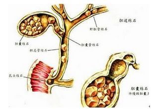 胆总管结石的内镜治疗