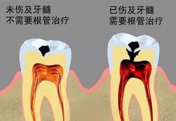 做了牙冠的牙还是疼(牙齿做了牙冠还有酸疼的感觉)