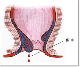 间歇性无痛便血更可怕,切勿疏忽 红色警告
