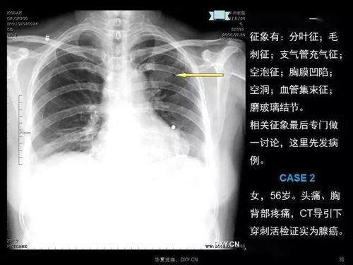 影像诊断鉴别 肺癌 肺炎 肺结核