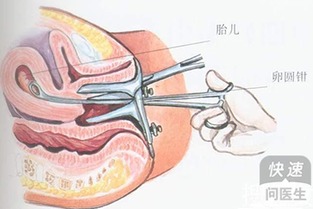 人工流产钳刮术的过程，要经历多大的痛苦呢(人工流产钳刮术评分标准)