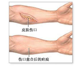 疤痕到底能不能根治呢 