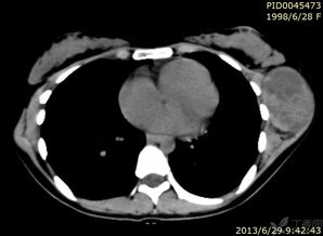 左侧胸部肿块,右侧肺内病变45473