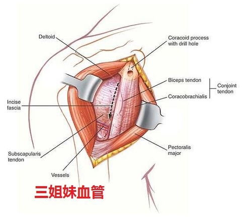 反肩置换三角肌胸大肌手术入路时要注意处理哪三姐妹血管 原创