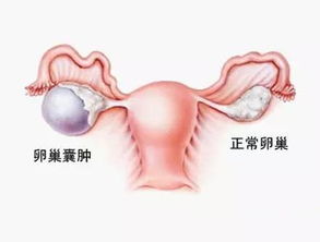 卵巢囊肿会引起小腹疼痛吗(卵巢囊肿会引起不规则出血吗)