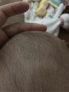 宝妈们,宝宝快7个月了,你们的宝宝头顶有凹陷明显的地方吗