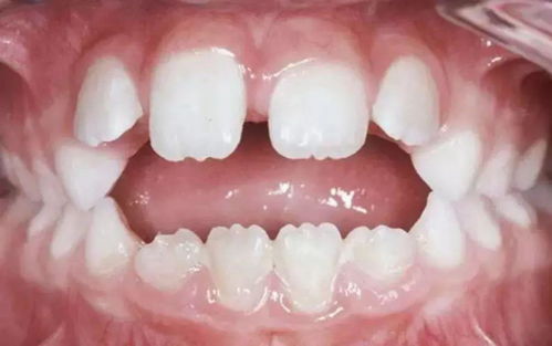 为什么牙医一眼就能看出孩子长期有口呼吸的习惯