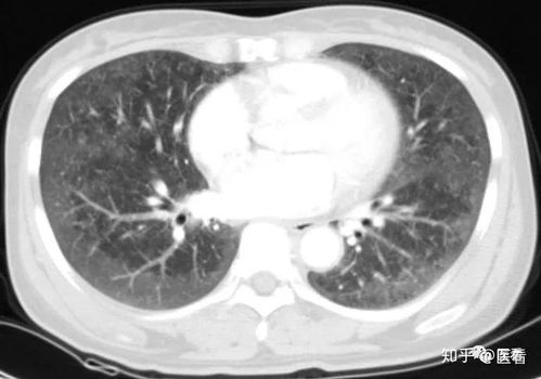 肺磨玻璃结节是肺癌吗 遇到肺磨玻璃结节莫惊慌 