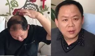 脱发秃顶遭人嫌弃怎么办 我要告诉你一个真实的生发故事,从一毛不拔到满头黑发全过程 