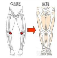 罗圈腿X型腿怎么变直