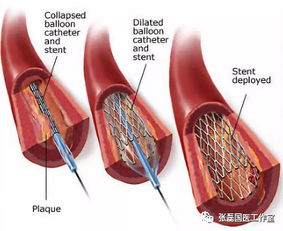 冬天腿脚发凉麻木是 老寒腿 警惕下肢动脉硬化闭塞症