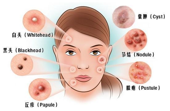 脸上冒痘这4个原因不可忽略