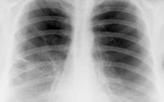 肺气肿症状 肺气肿的症状表现有什么