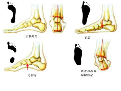 扁平足跑步容易受伤 是因为你这里的肌肉太薄弱