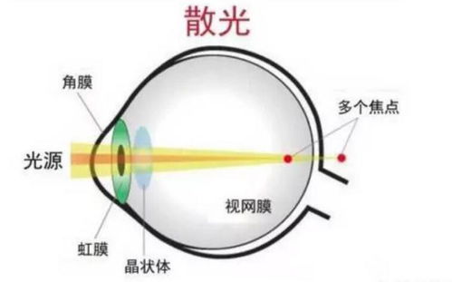 近视通常伴随着散光,什么是散光,如何预防与纠正散光