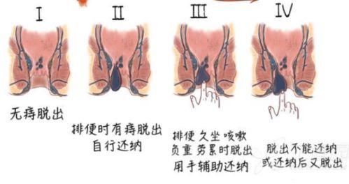 痔疮手术要多少钱