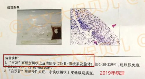 cin2 3级累及腺体,宫颈癌前病变手术后,该怎么买保险