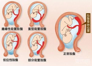 胎盘部分残留有哪些并发疾病