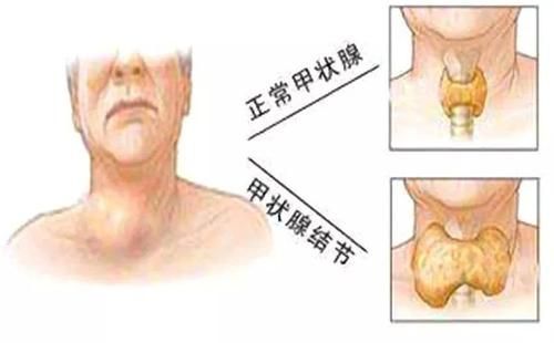 甲状腺有结节不能吃发物 代文新专家 要根据自身的情况来判断