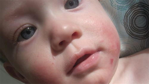 婴儿湿疹怎么办 宝宝脸上长湿疹怎么办