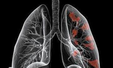 肺癌早期会有哪些表现 咳嗽是肺癌的早期表现吗