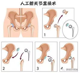 股骨头坏死 坐 视不理 麦瑞钽棒支撑术微创治疗,安全保髋