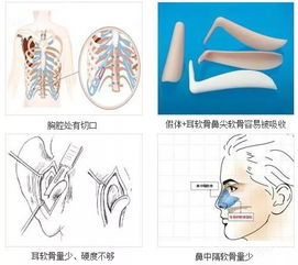 逆龄社 异体骨隆鼻,再生骨鼻综合