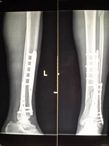 左小腿胫腓骨骨折图片 信息评鉴中心 酷米资讯 Kumizx Com