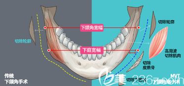 面部不对称矫正手术多少钱 不同原因不同矫正价格请参考