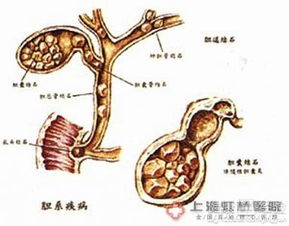 检查胆囊结石多发1513mm最先进治疗方法