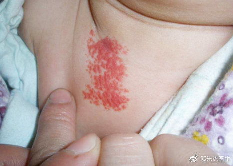 注意 婴儿毛细血管瘤的这些症状,家长可别当成了 湿疹