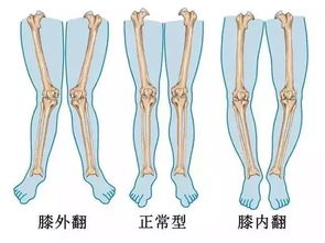 宝宝1岁8个月x型腿正常吗(一岁八个月x型腿)