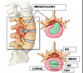 广州朋友问腰椎间盘突出为什么引发腿痛 腿麻