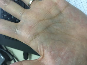 两个手掌上都有条像疤痕的线, 而且是涨在同一个地方,手掌用力摊开会更明显,不知道是怎么回事 