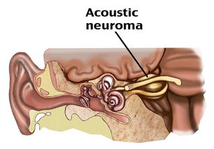 听神经瘤治疗新技术,能否保留听力以及不损伤面部神经