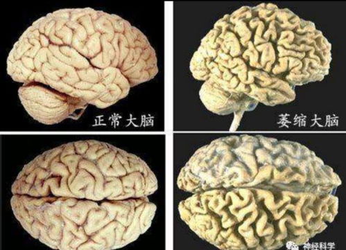 脑萎缩一般多大年龄会出现 