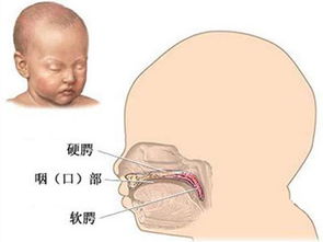 孕期感冒有可能导致宝宝唇腭裂 