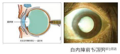 关于白内障的知识(关于白内障的治疗方法)