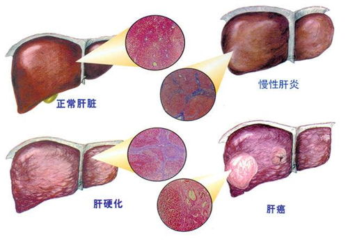 乙肝抗纤维化与抗病毒能同步进行吗