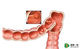 大肠癌 钟情 哪些人