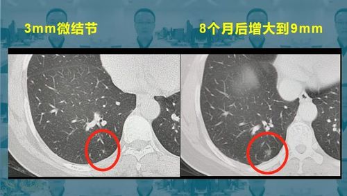 请问肺部磨玻璃结节9mm需要手术吗