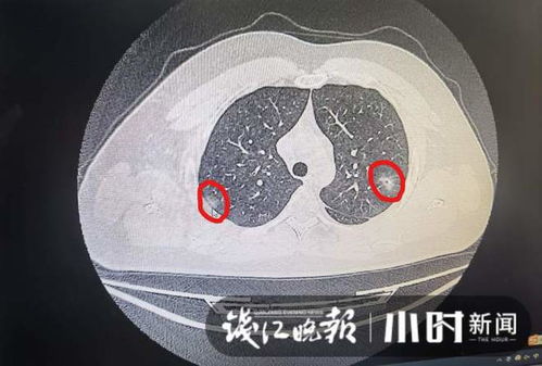 久咳担心肺炎,不少人到杭州各医院做肺部CT,什么情况要重视 浙大二院医生详解