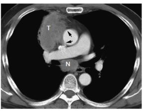 原发性肺部肿瘤的可切除性 影像学评估